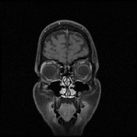 My Brain. Brain MRI Pictures.
