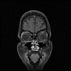 My Brain. Brain MRI Pictures.