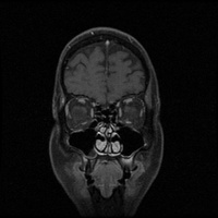 My Brain. Brain MRI Pictures.