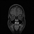 My Brain. Brain MRI Pictures.