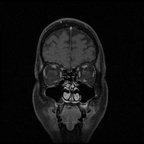 My Brain. Brain MRI Pictures.