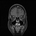 My Brain. Brain MRI Pictures.