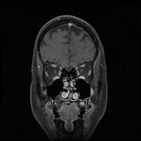 My Brain. Brain MRI Pictures.