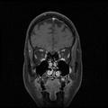 My Brain. Brain MRI Pictures.