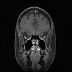 My Brain. Brain MRI Pictures.