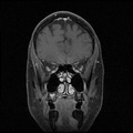 My Brain. Brain MRI Pictures.