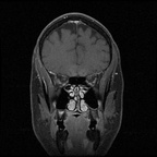 My Brain. Brain MRI Pictures.