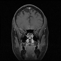 My Brain. Brain MRI Pictures.