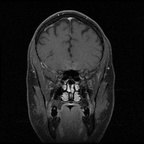 My Brain. Brain MRI Pictures.