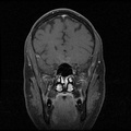 My Brain. Brain MRI Pictures.