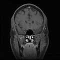 My Brain. Brain MRI Pictures.