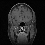 My Brain. Brain MRI Pictures.