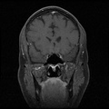 My Brain. Brain MRI Pictures.