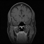 My Brain. Brain MRI Pictures.