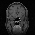 My Brain. Brain MRI Pictures.