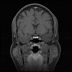 My Brain. Brain MRI Pictures.