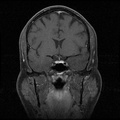 My Brain. Brain MRI Pictures.