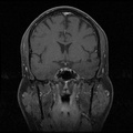 My Brain. Brain MRI Pictures.