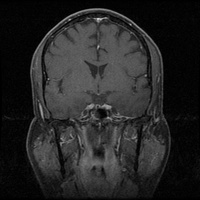 My Brain. Brain MRI Pictures.