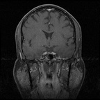 My Brain. Brain MRI Pictures.