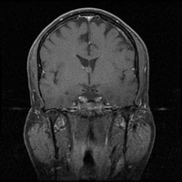 My Brain. Brain MRI Pictures.