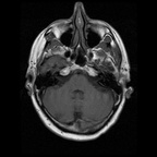 My Brain. Brain MRI Pictures.