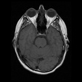 My Brain. Brain MRI Pictures.