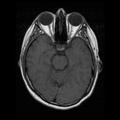 My Brain. Brain MRI Pictures.