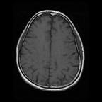 My Brain. Brain MRI Pictures.