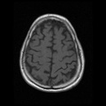 My Brain. Brain MRI Pictures.