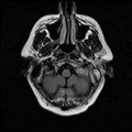 My Brain. Brain MRI Pictures.