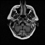 My Brain. Brain MRI Pictures.