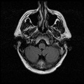 My Brain. Brain MRI Pictures.