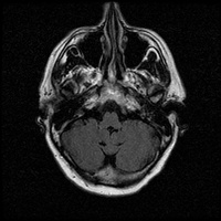 My Brain. Brain MRI Pictures.