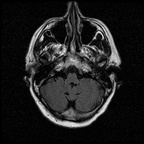 My Brain. Brain MRI Pictures.