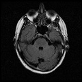 My Brain. Brain MRI Pictures.