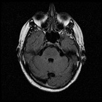 My Brain. Brain MRI Pictures.