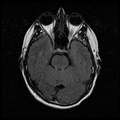 My Brain. Brain MRI Pictures.