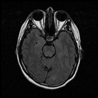 My Brain. Brain MRI Pictures.
