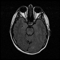 My Brain. Brain MRI Pictures.