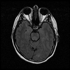 My Brain. Brain MRI Pictures.