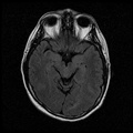 My Brain. Brain MRI Pictures.