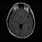 My Brain. Brain MRI Pictures.