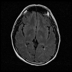 My Brain. Brain MRI Pictures.