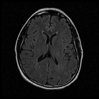 My Brain. Brain MRI Pictures.