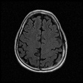 My Brain. Brain MRI Pictures.