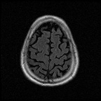 My Brain. Brain MRI Pictures.