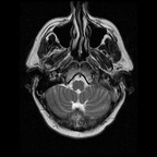 My Brain. Brain MRI Pictures.