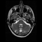 My Brain. Brain MRI Pictures.