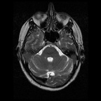 My Brain. Brain MRI Pictures.